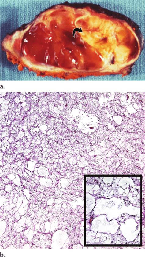 Pathologic Features Of Myxoid Liposarcoma In A 28 Year Old Man With A