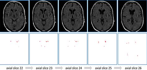 Pdf Fully Convolutional Network Ensembles For White Matter