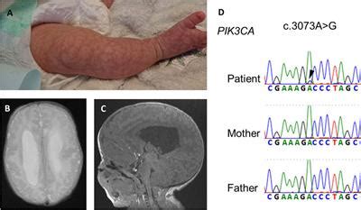 Frontiers Case Report Progressive Pulmonary Artery Hypertension In A