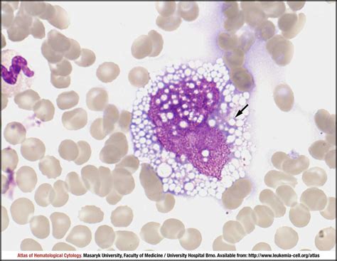 Anaplastic Large Cell Lymphoma Alk Positive Cell Atlas Of