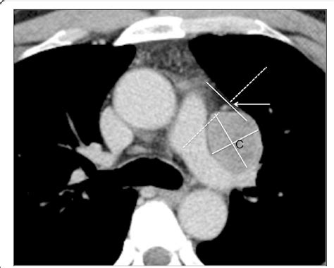 A Case Involving A Metastatic Tumor Derived From Renal Cell Carcinoma