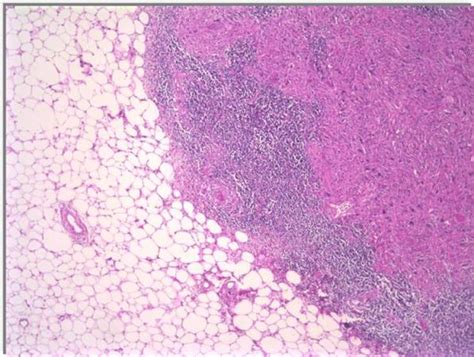 Liposarcoma Pathology Orthobullets