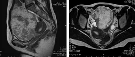 Magnetic Resonance Imaging Findings A Pelvic T2 Weighted Imaging