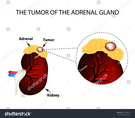 3,241 Adrenal cancer Images, Stock Photos & Vectors | Shutterstock