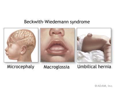 The New York Times Health Image Beckwith Wiedemann Syndrome