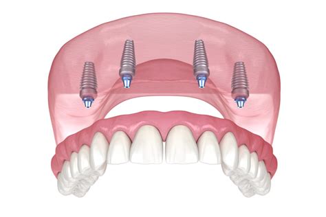 Cover Denture Mehr Sicherheit Und Halt F R Prothesentr Ger Ilovemysmile