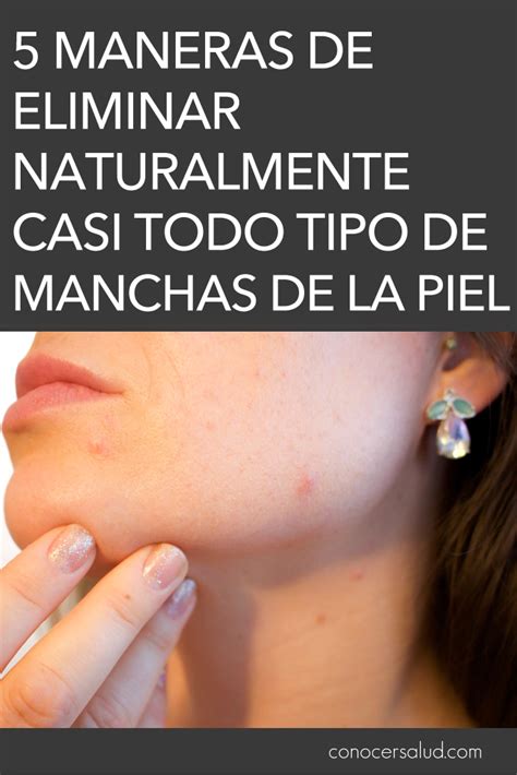 5 Maneras De Eliminar Naturalmente Casi Todo Tipo De Manchas De La Piel