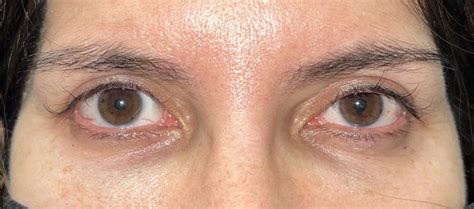 4 Upper Eyelid Surgery Before And After Photos Dallas Plano Texas Cosmetic Reconstructive