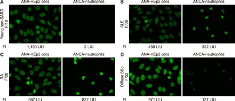 Nuclear Staining Patterns Of Hep 2 Cells And Neutrophils In Patients