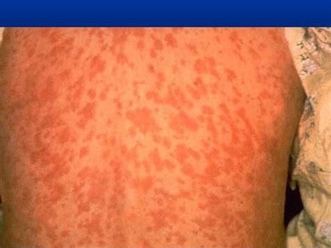 fifth disease rash pictures - pictures, photos