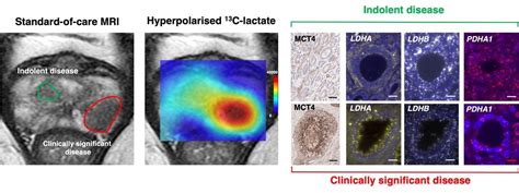 Dissecting Prostate Cancer Metabolic Compartmentalization Using Digital