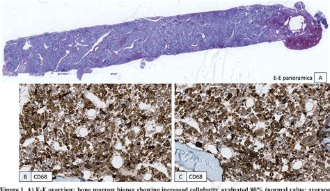 Figure 1 From Hemophagocytic Syndrome In A Patient With Disseminated