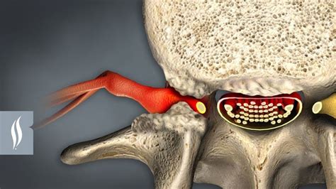 What Is Foraminal Narrowing Laser Spine Institute Stenosis Spines Laser