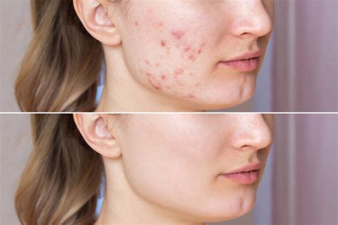 Understanding Adult Acne Causes Remedies And Prevention