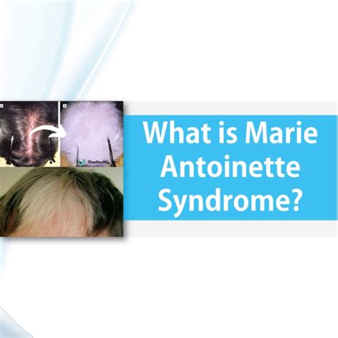 Marie Antoinette Syndrome - Can Your Hair Turn White Overnight? - Rish Academy