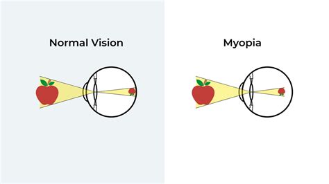 What is Myopia? Causes & Treatment of Short Sightedness