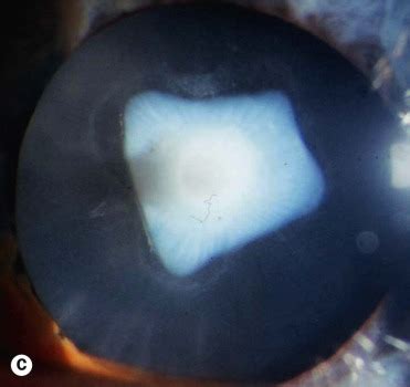 Snowflake Cataract Diabetes - DiabetesWalls