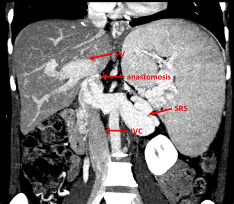 Establishing Portal Inflow With Diffuse Splanchnic Venous Thrombosis