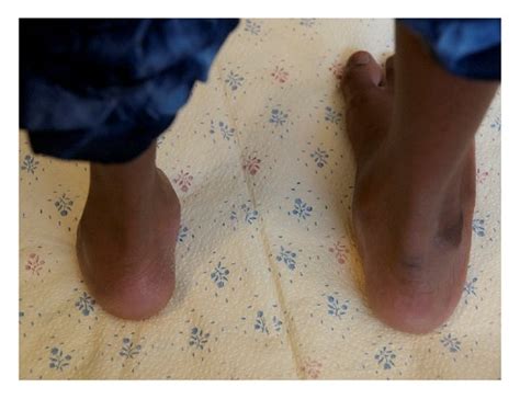 Clubfoot status after revision surgery with recurrent deformity ...