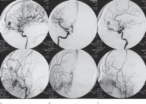 Figure From Transarterial Embolization Of Dural Arteriovenous