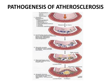 Ppt Atherosclerosis Powerpoint Presentation Free Download Id 9603452