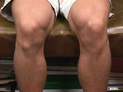 Jannah~ Osgood Schlatter Disease~