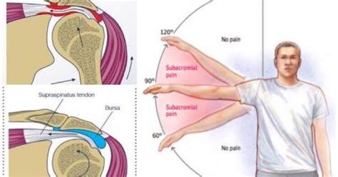 Understanding Impingement Syndrome Causes Symptoms And Treatment