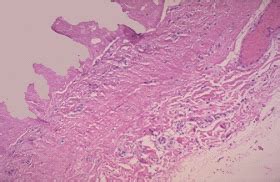 MEDICAL CHOICES: Fibrinous Pericarditis Histology and Explanation