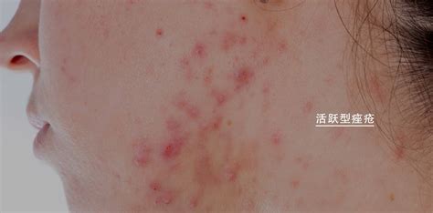 Types Causes And Treatment For Acne Ensoul Medical Clinic