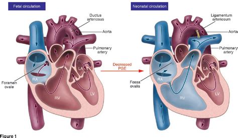 Figure 1 From The Paradoxical Patent Ductus Arteriosus Semantic Scholar