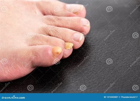 Yellow Male Fingernail with Fungus Stock Image - Image of deformed ...