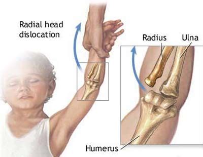 Children Pulled Elbow | 🩺Singapore Sports & Orthopaedic Surgeon