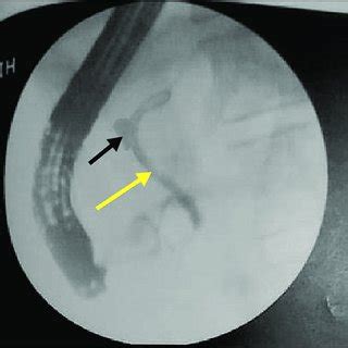 Cholangiogram At Endoscopic Retrograde Cholangiopancreatography Ercp