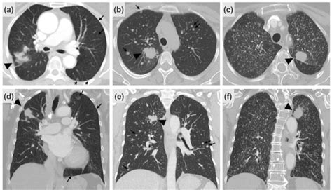 Representative radiological findings of (a, d) nonmiliary pulmonary ...