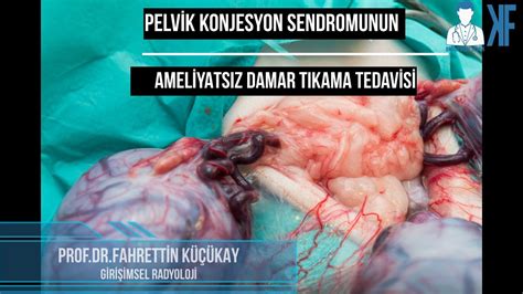 Pelvik konjesyon sendromunun ameliyatsız damar tıkama ile tedavisi