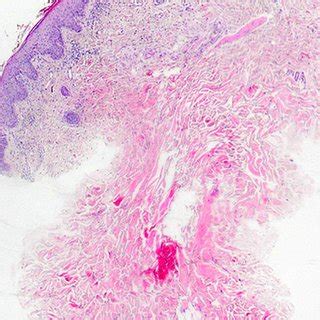 Epidermis shows slightly regular acanthosis and mild spongiosis (×40 ...