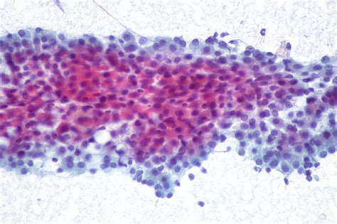 Warthin Tumor Of Parotid Fna Ed Uthman Flickr