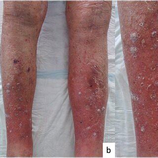 A Patient S Legs Before Dupilmab B Patient S Legs 2 Months After