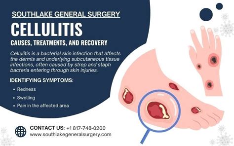 Cellulitis: Causes, Treatments, and Recovery - Southlake General Surgery : r/Laparoscopy