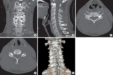 Cervical Spine Anatomy Ct Scan