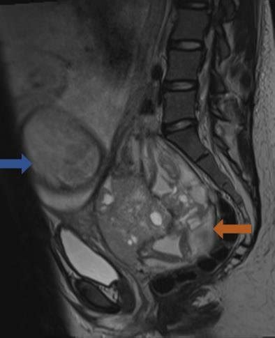 Non Contrast MRI Sagittal T2 Weighted Image Demonstrating Large