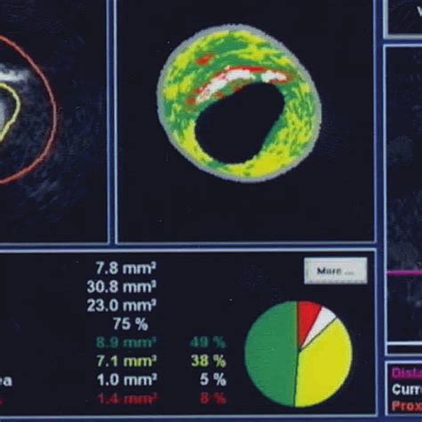 Virtual Histology Intravascular Sonography Mapping Of Carotid