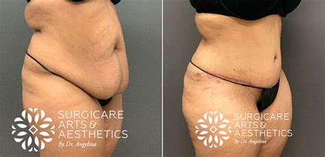 Panniculectomy Vs Tummy Tuck Before And After Photos