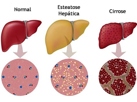 Esteatose ou doenças hepáticas gordurosas saiba mais