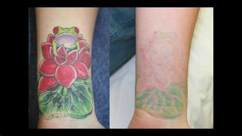 Top more than 68 color tattoo removal before and after super hot - in ...