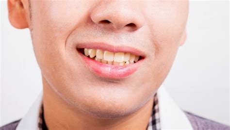 Causes Of Tooth Discoloration And How To Prevent And Treat It