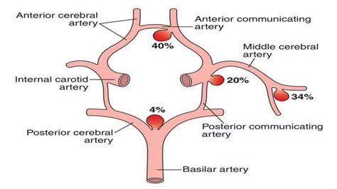 Cerebral Aneurysm Ppt