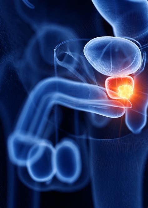 What Causes Prostate Cancer?