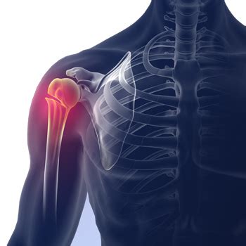 Shoulder Fracture Monterey | Clavicle Fracture | Humerus Fractures Pebble Beach