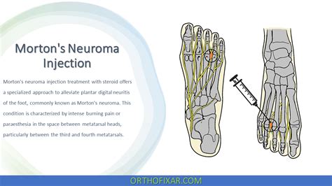 Morton S Neuroma Injection